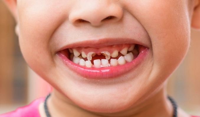 Hình ảnh rụng nhiều răng