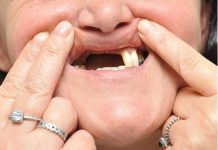 Nằm mơ thấy mình rụng răng là điềm hung hay cát? Nằm mơ thấy mình rụng răng đánh con gì để trúng lớn?