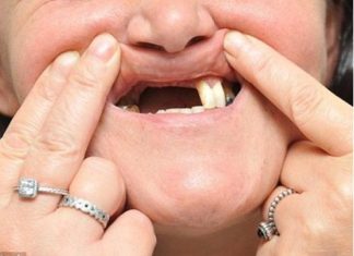 Nằm mơ thấy mình rụng răng là điềm hung hay cát? Nằm mơ thấy mình rụng răng đánh con gì để trúng lớn?