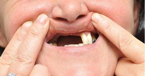 Nằm mơ thấy mình rụng răng là điềm hung hay cát? Nằm mơ thấy mình rụng răng đánh con gì để trúng lớn?